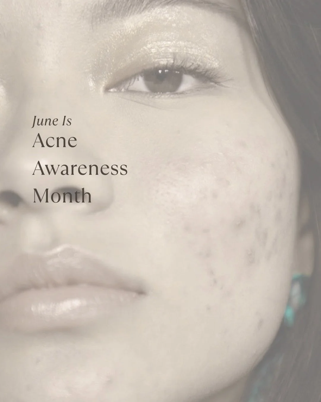This Acne Awareness Month we want to remind you that acne is incredibly common and completely human. Skin journeys take time, consistency and support 🤍