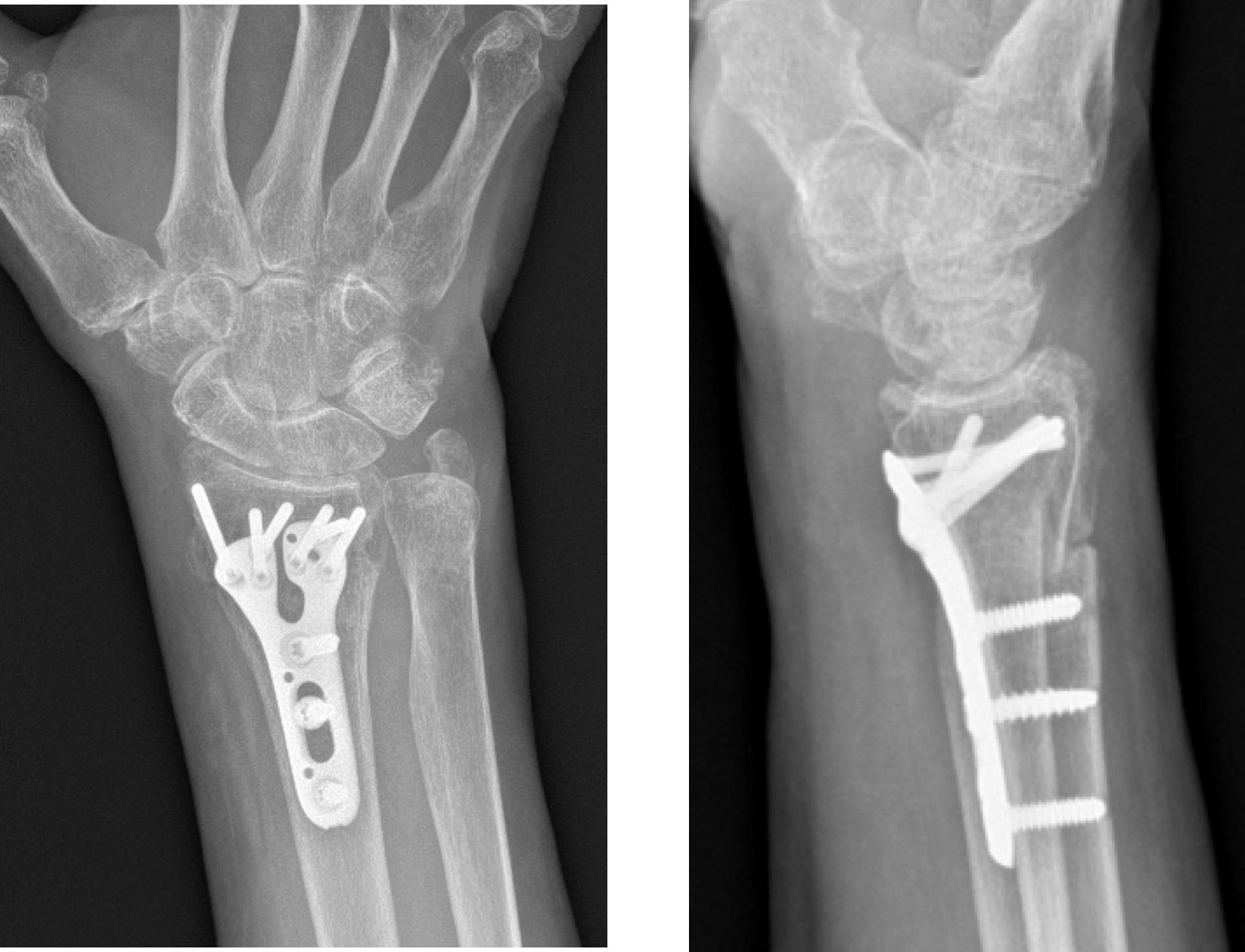 Fracture Distal End Radius _ Frykman classification of distal radial ...
