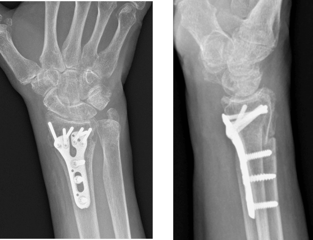 A Patient’s Guide to Distal Radius Fractures — Dr. Nick Golinvaux