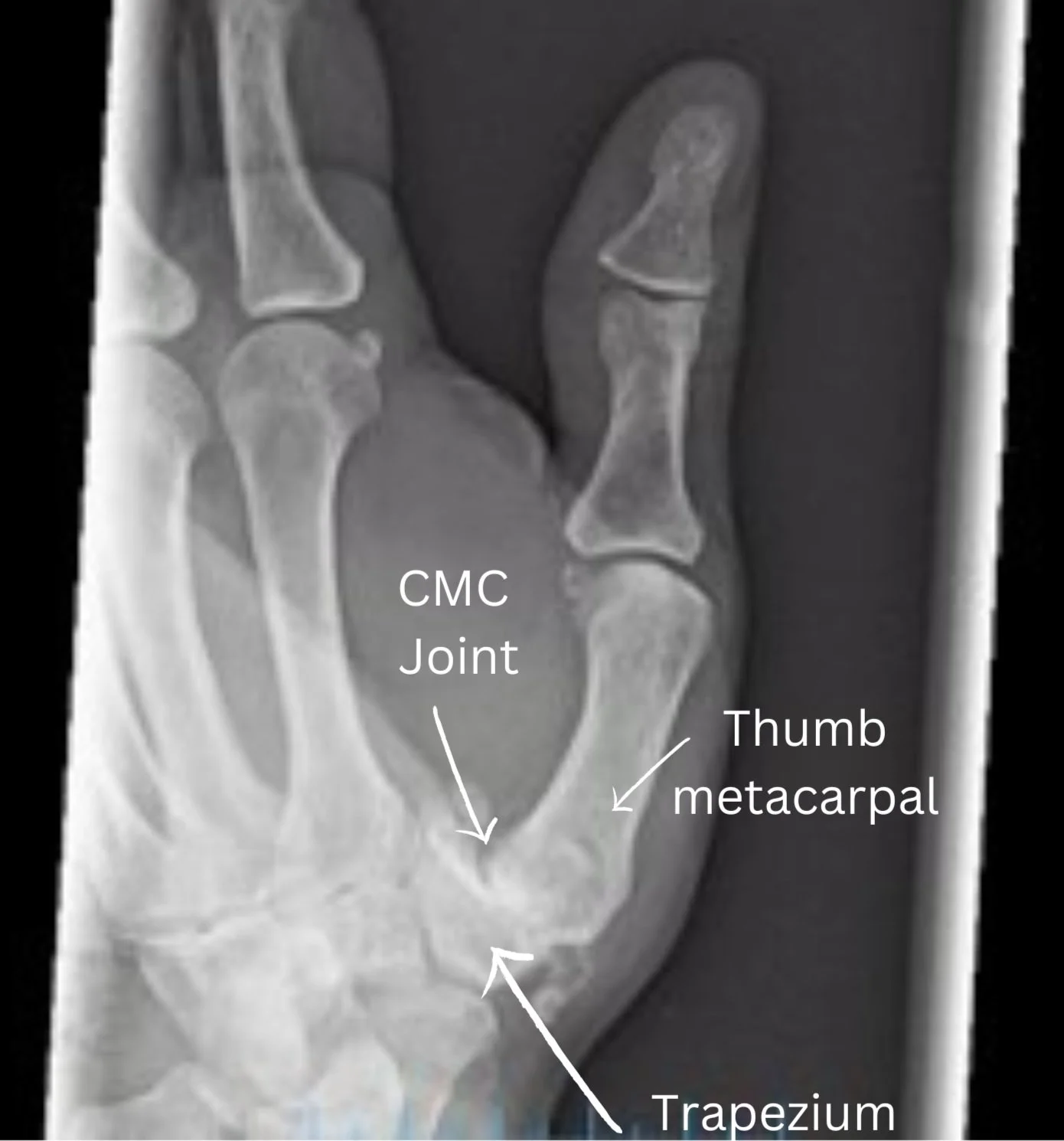 What Is Thumb Cmc Arthritis The Ultimate Guide For Patients Dr Nick What Is Thumb Cmc Arthritis The Ultimate Guide For Patients Dr Nick