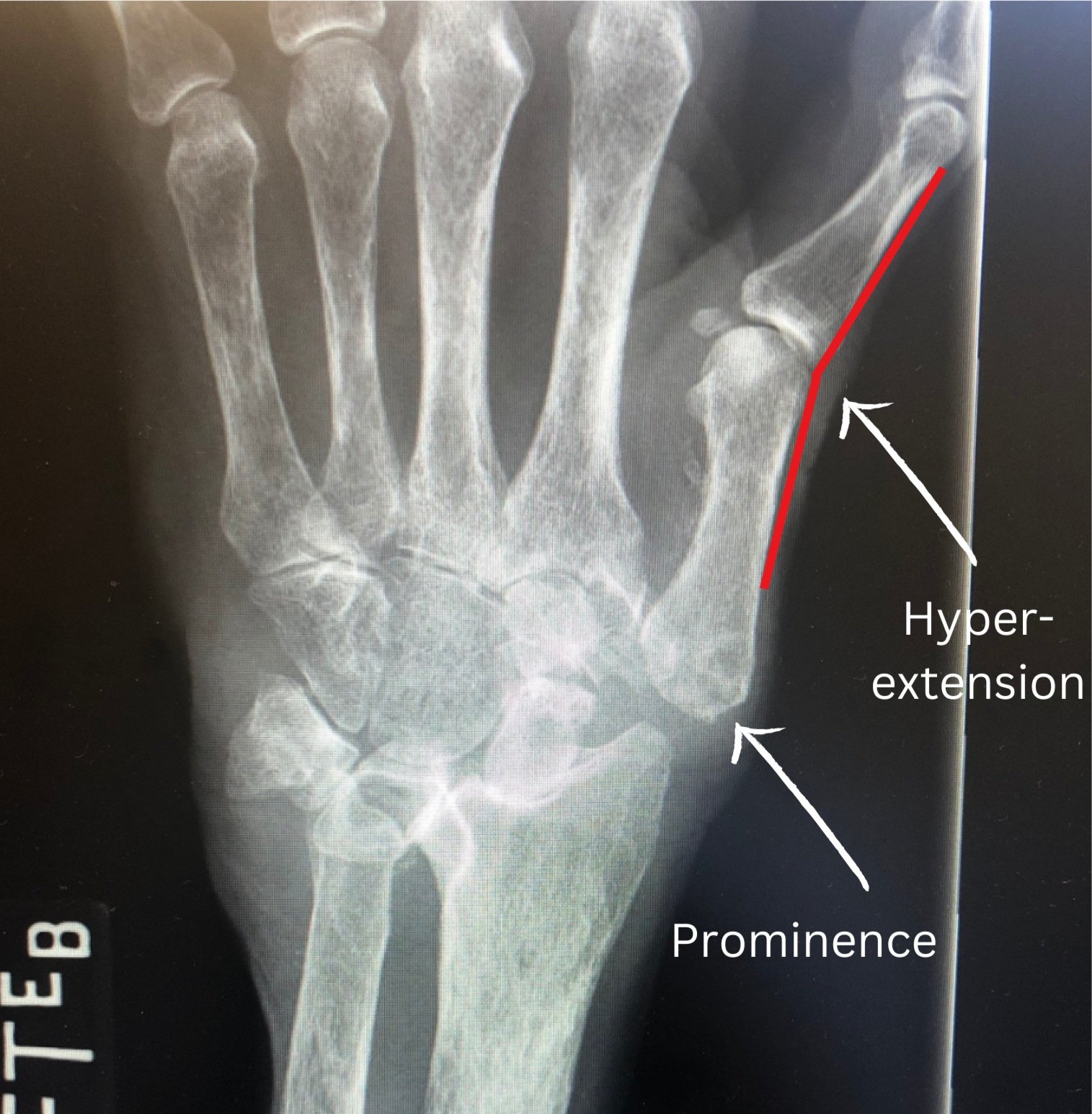 What Is Thumb CMC Arthritis? The Ultimate Guide For Patients — Dr. Nick ...