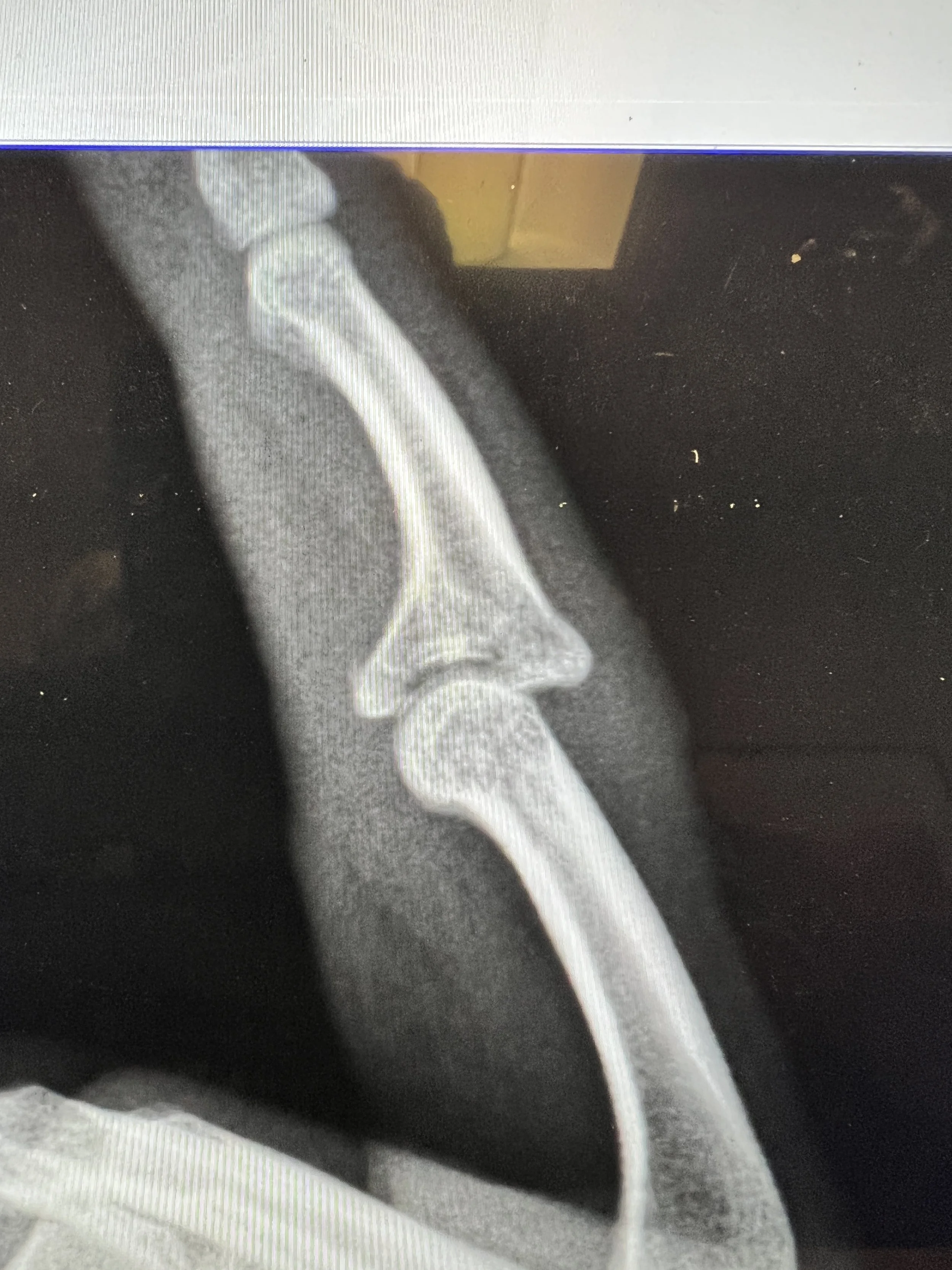 Jammed Finger (Sprain or Fracture) Denver, Colorado — Dr. Nick Golinvaux