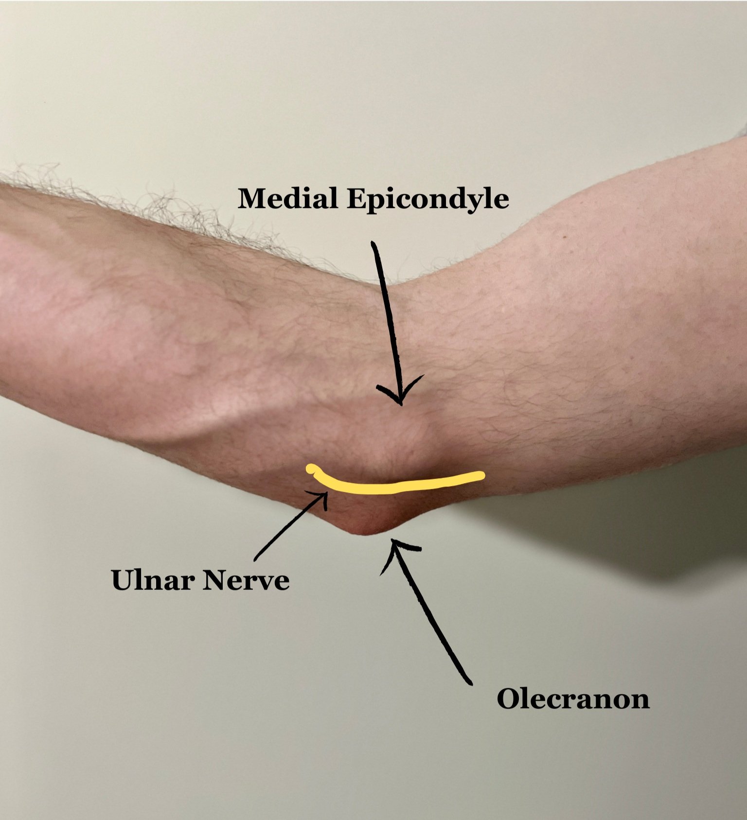 What Is Cubital Tunnel Syndrome? The Ultimate Patient Guide — Dr. Nick ...