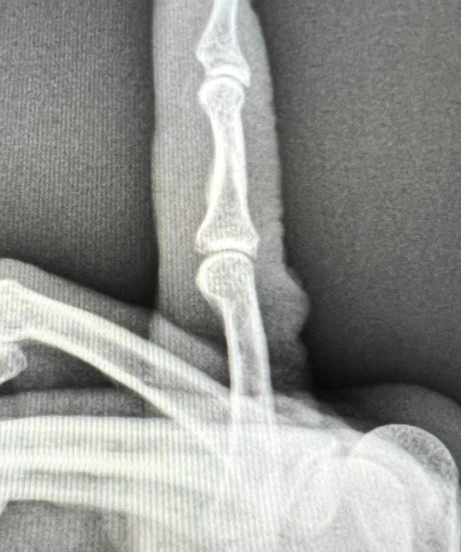 I Jammed My Finger…How Do I Know If It’s Broken? — Dr. Nick Golinvaux