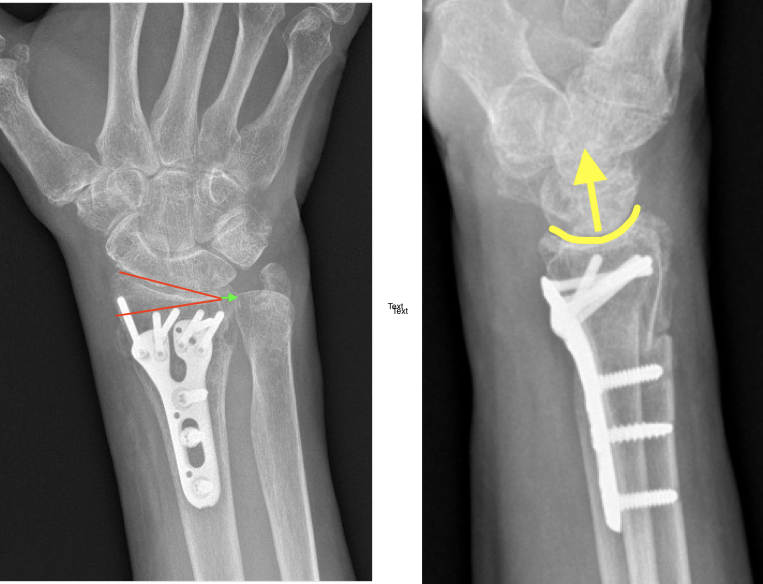 I Have A Broken Wrist A Primer on Distal Radius Fracture Surgery — Dr