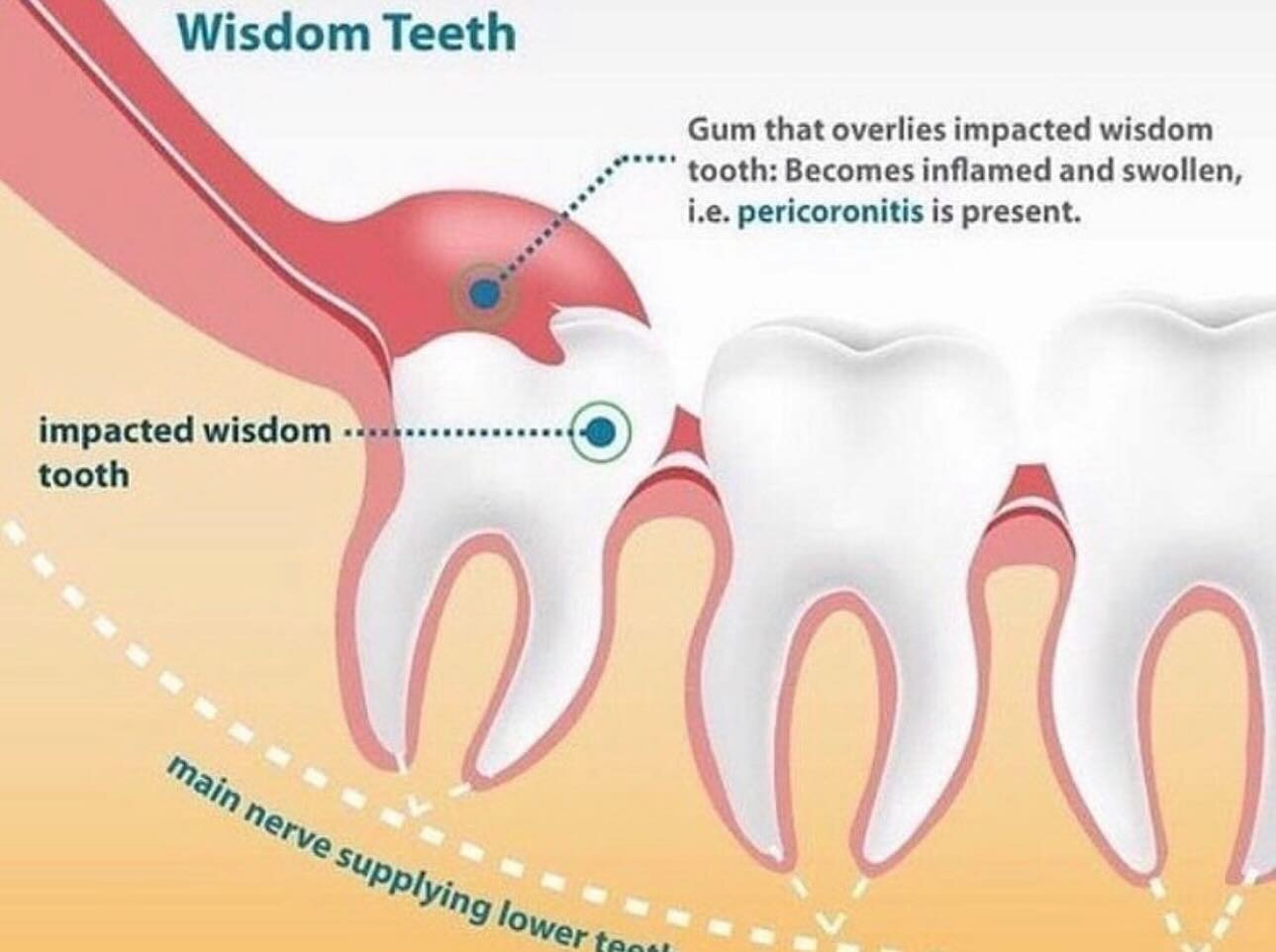 🦷 Wisdom teeth usually start to show in your mouth (erupt) during late adolescence. If there is not enough room for them to come through your gums fully, it can lead to pericoronitis, which is inflammation of the tissue surrounding the tooth. 😬 Thi