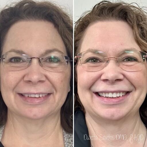 It&rsquo;s not just about a brighter smile, it&rsquo;s about the joy that radiates from a new smile!! 😀 

#invisalign #invisalignjourney #dentistlife #dentalwork #beforeandafter #clevelanddentist #everythingstartswithasmile #chagrinfalls #chagrinfal