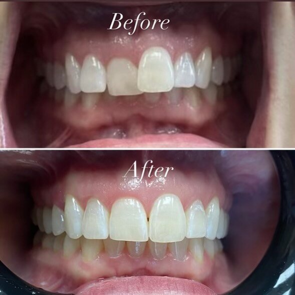 Have you ever seen such a satisfying #beforeandafter ??

#chagrinfalls #clevelanddentist #invisalign