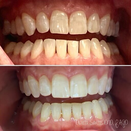 Invisalign doesn&rsquo;t just make your smile prettier&hellip;it&rsquo;s an important part of your oral health! This patient went on their Invisalign journey so they could close spaces between teeth and most importantly, reduce wear and impact on the