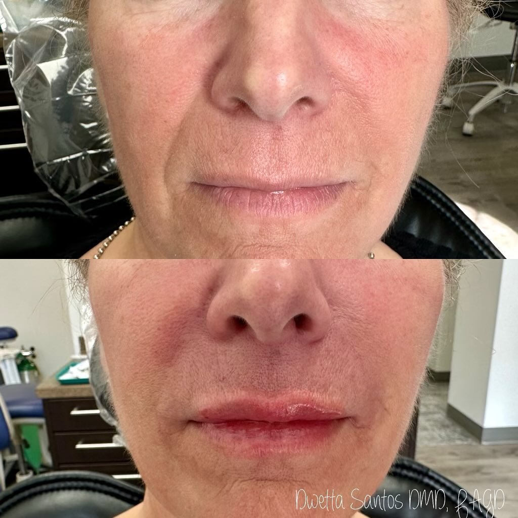 🏝️ Getting ready for the summer season doesn&rsquo;t just include putting out your patio set and filling up the propane tanks&hellip;it means making sure your smile is framed the way you want it! 

This beautiful #BeforeandAfter is from a patient wh