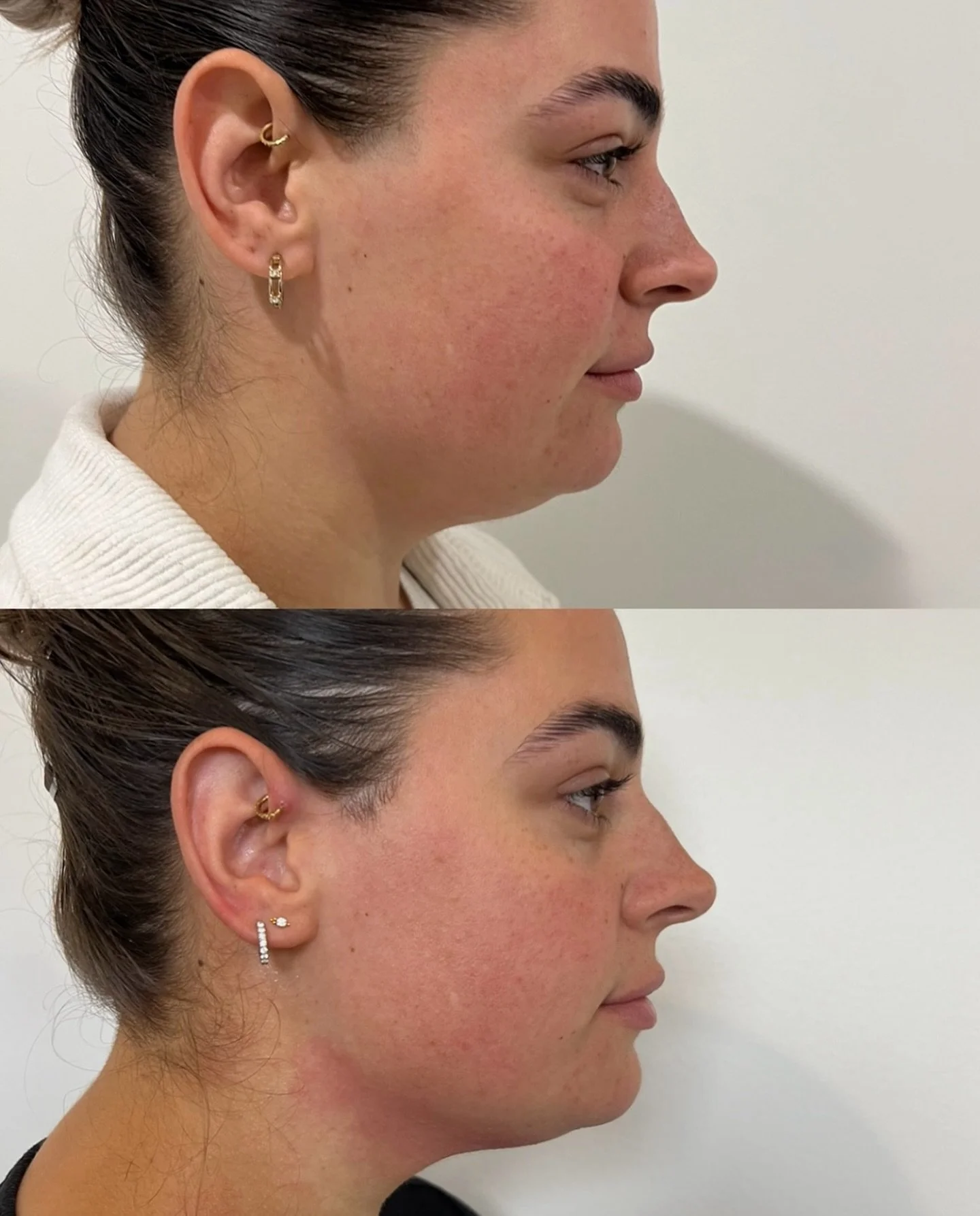 Serving you a jawline so sharp it could cut your ex out of photos 😉

this was achieved with 60 units of fat dissolve (equivalent to 6 sessions)