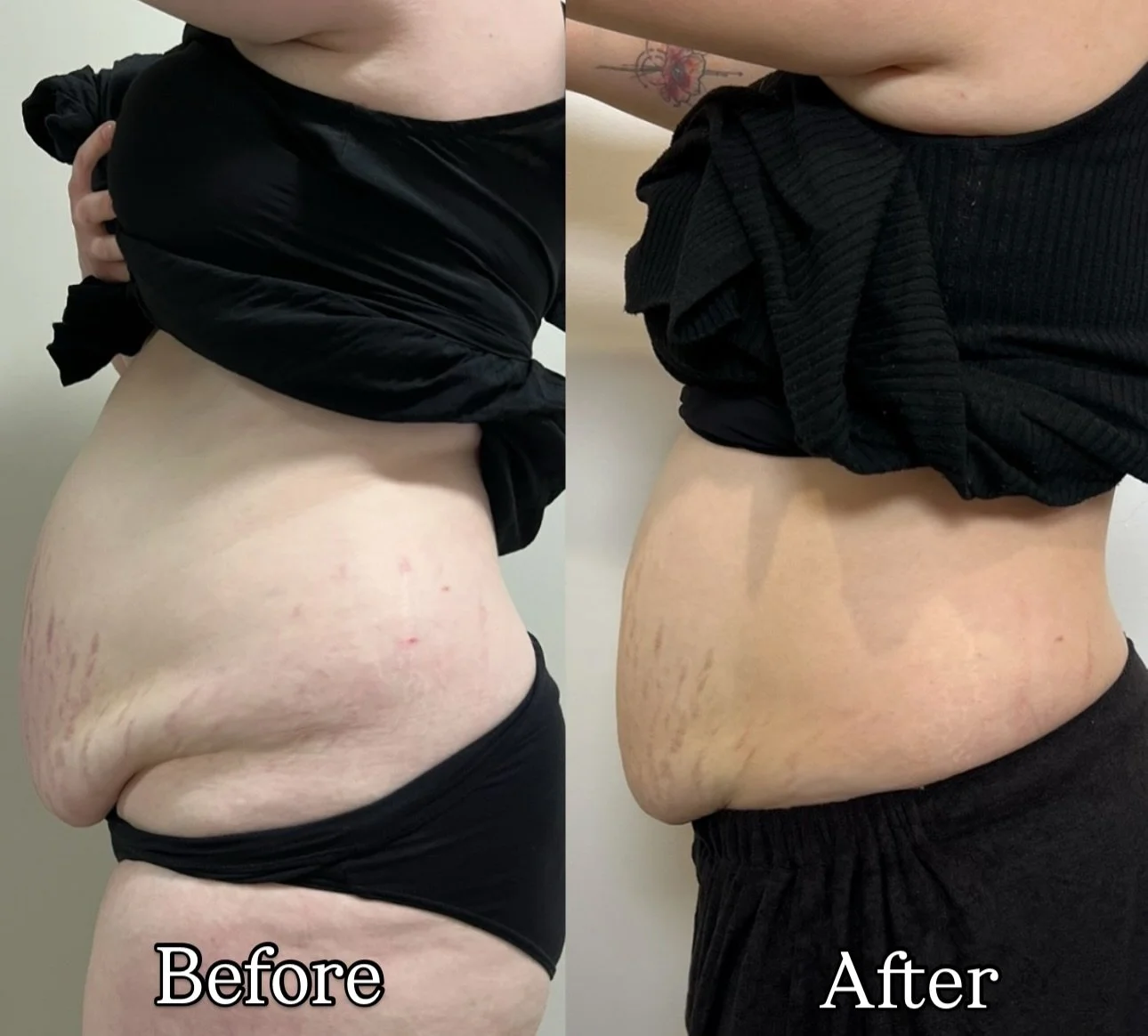 No filters. No surgery. Just 9 sessions of fat dissolve and a whole lot of &ldquo;where did it go?!&rdquo; 🤭