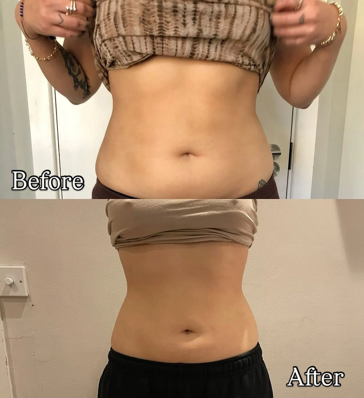 ✨Snatched &amp; Sculpted✨
No gym, no surgery, no stress. Just fat dissolve magic. 🔥 Look at this amazing transformation &mdash; smoother, flatter, and way more defined after just a few sessions! This client had 9 sessions of fat dissolve done to ach
