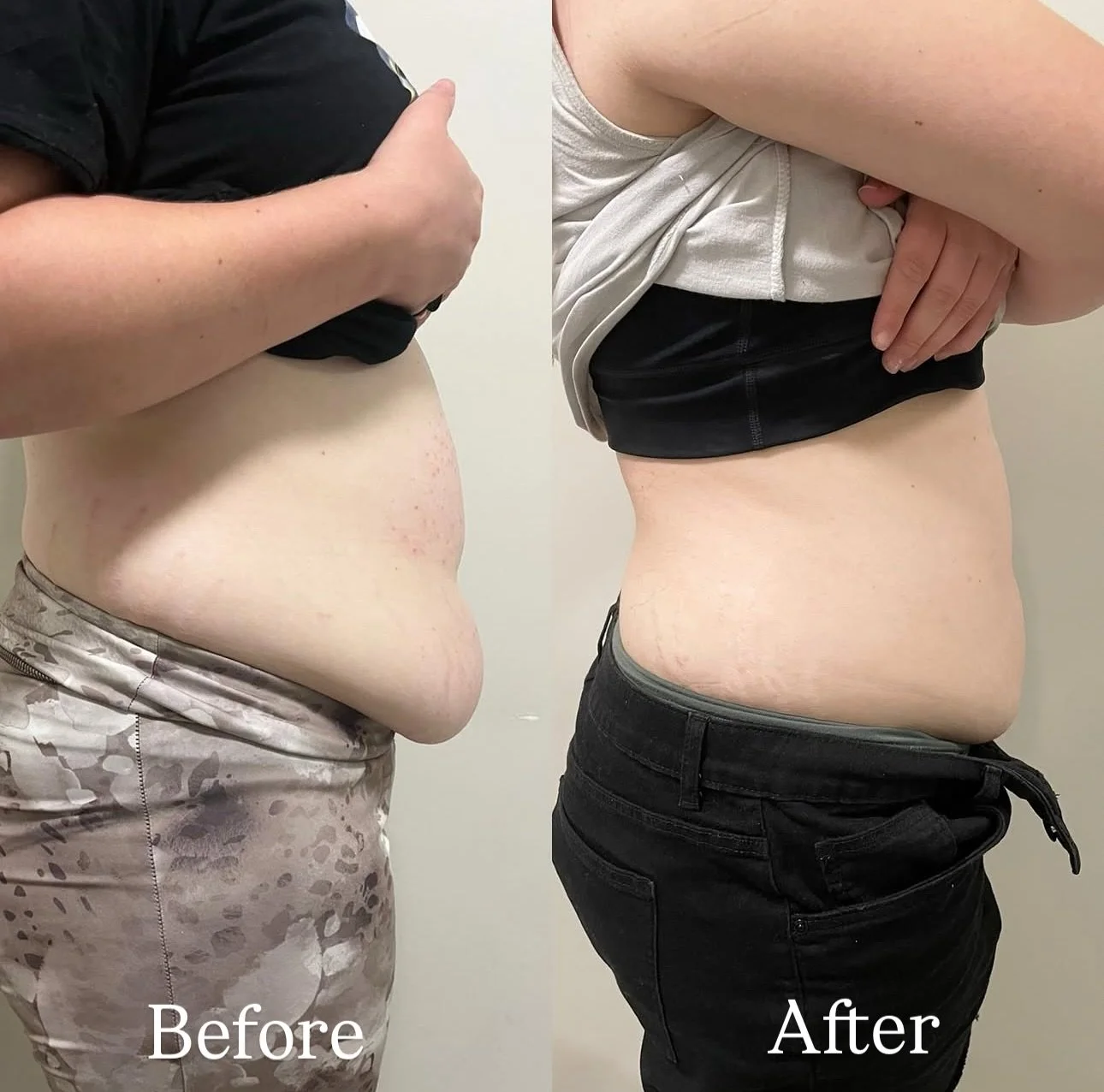 ✨Before &amp; After✨
Our client is glowing with confidence after their fat dissolve sessions! 💕 Look at that tummy transformation &mdash; smoother, flatter, and snatched 🙌
Who&rsquo;s ready for their own before &amp; after moment? 💫

A total of 12
