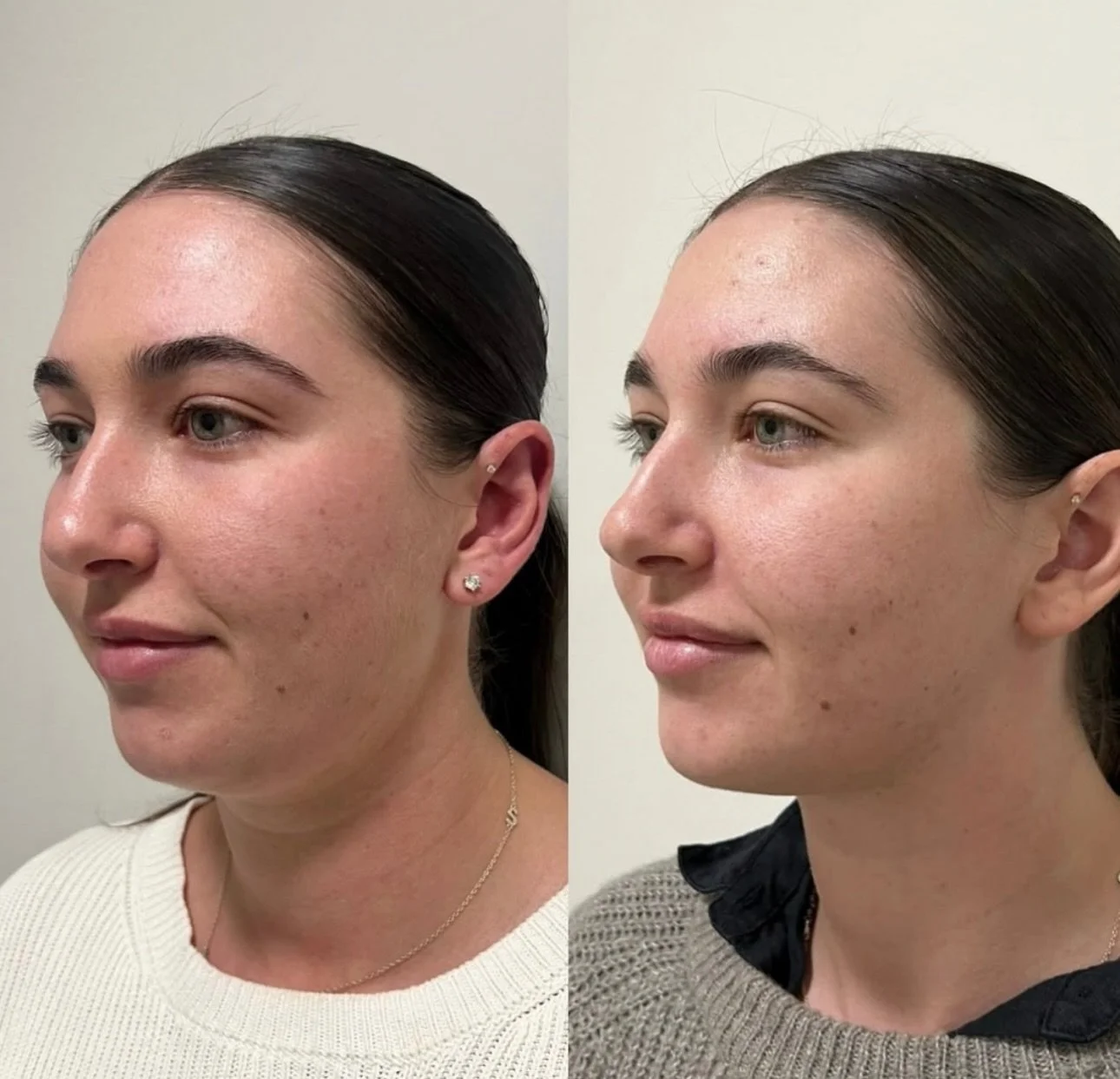 Not Photoshop, not Facetune&hellip; just science 💉✨ 

Fat dissolve works by breaking down those stubborn fat cells under the chin so your body naturally flushes them out. Think of it as sending your double chin on a permanent vacation 🏖️. 

Because