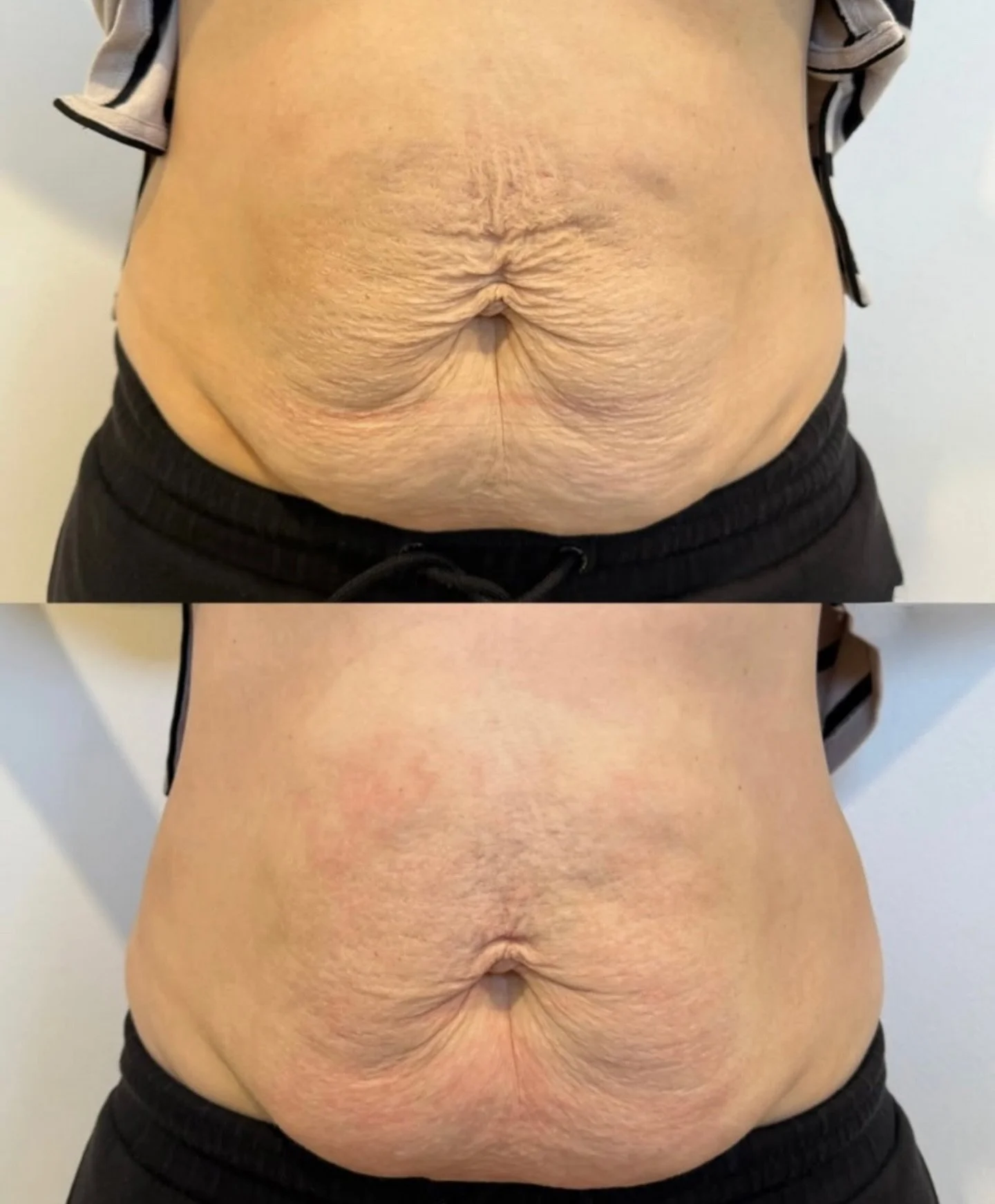 THIS IS ONE TREATMENT AFTER OUR HIFU SKIN TIGHTENING TREATMENT 😍

Loose skin after weight loss or babies? 👶➡️🔥 HIFU gives your tummy the snatched, lifted look without surgery. One session is usually all it takes to tighten + tone from the inside o