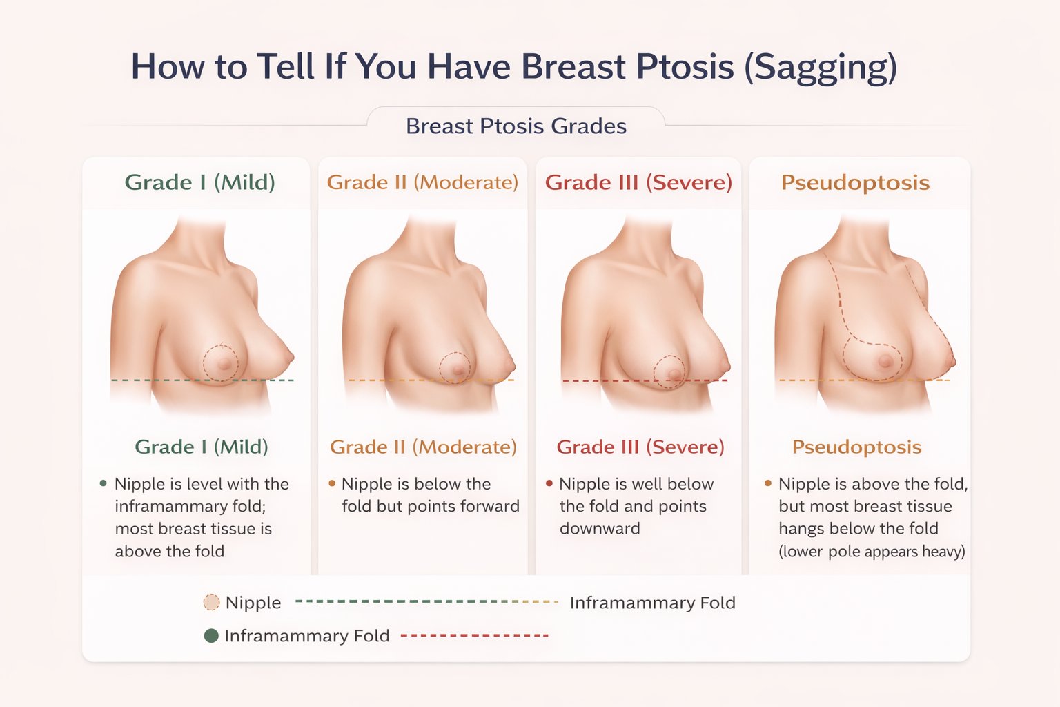 How to Tell If You Have Breast Ptosis (Sagging)
