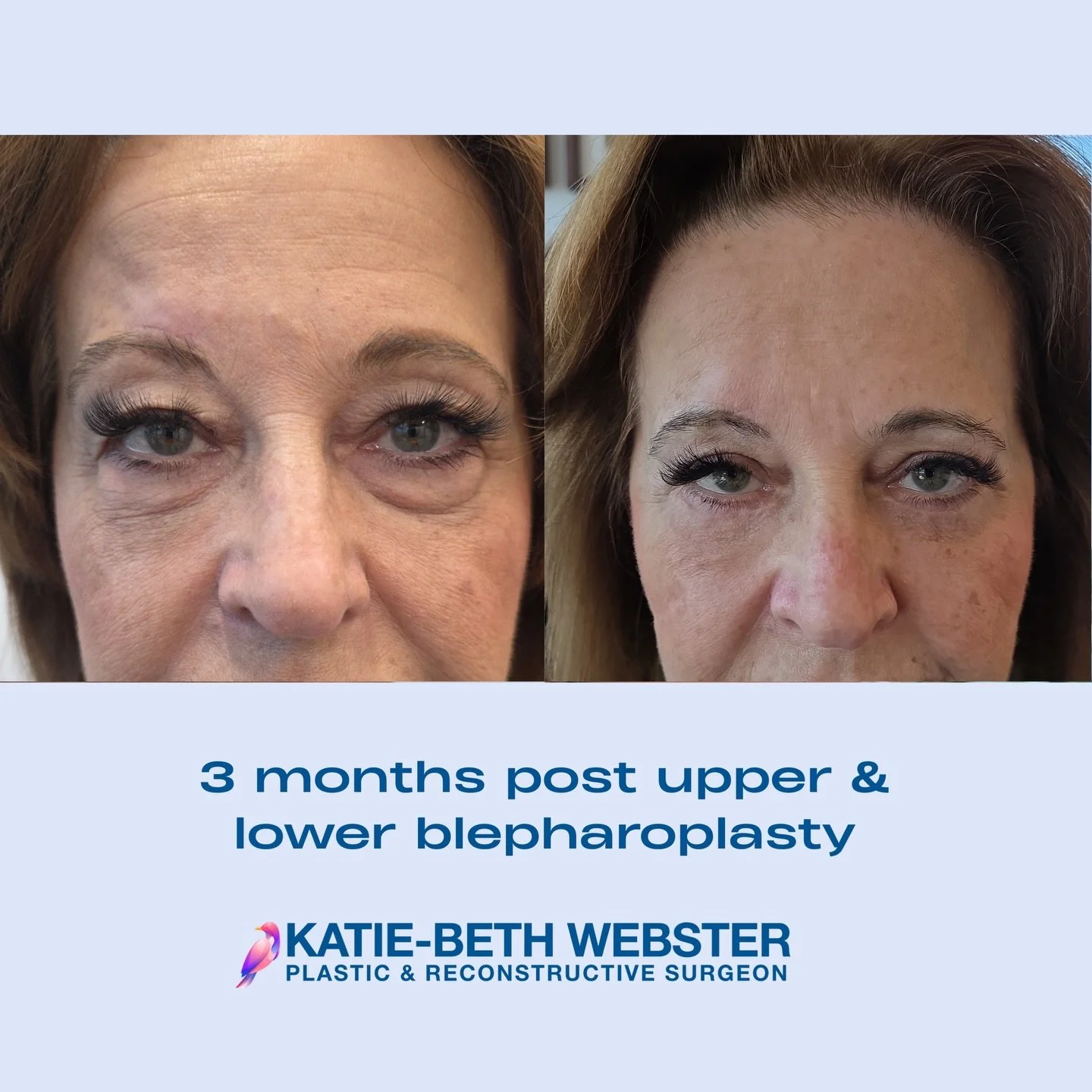 Bilateral upper &amp; lower blepharoplasty with Dr Webster

Dr Katie-Beth Webster is a specialist Plastic and Reconstructive Surgeon, Melbourne, Australia.
MED0001677984

Photos posted with patient consent. Individual results may vary from patient to
