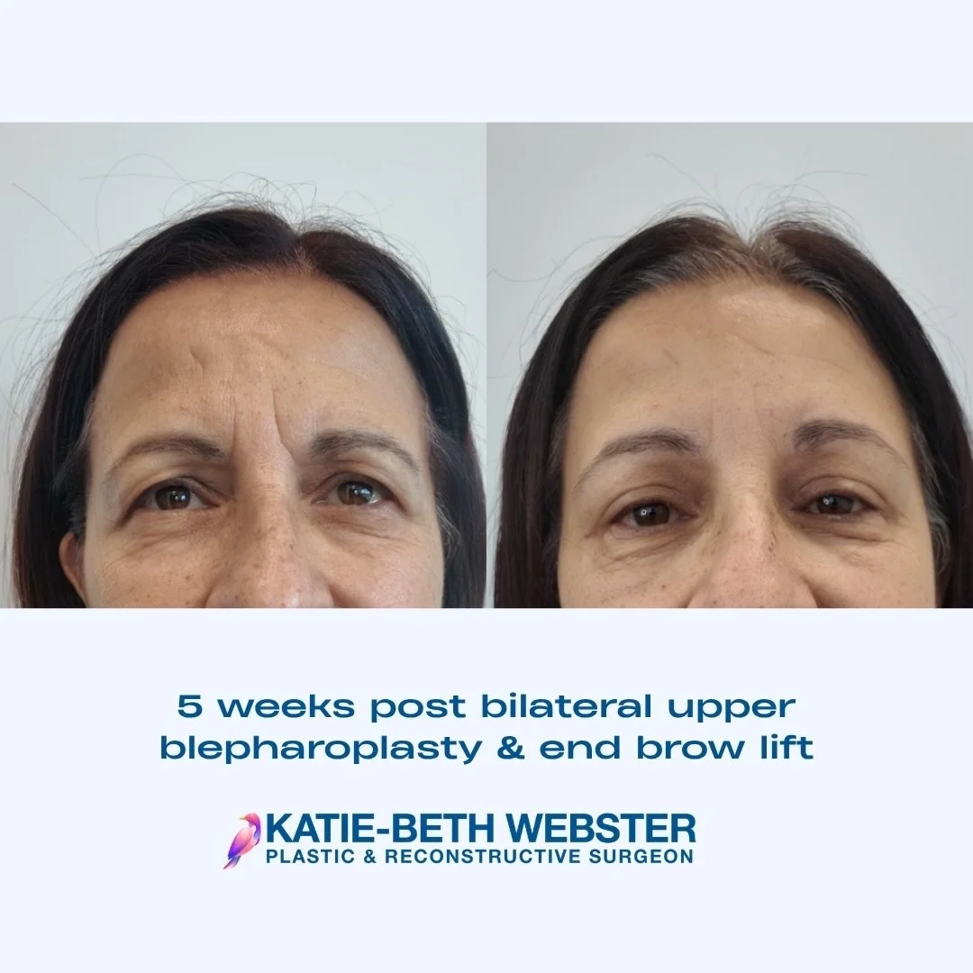 Bilateral Upper Blepharoplasty &amp; End Brow Lift with Dr Webster

Dr Katie-Beth Webster is a specialist Plastic and Reconstructive Surgeon, Melbourne, Australia.
MED0001677984

Photos posted with patient consent. Individual results may vary from pa