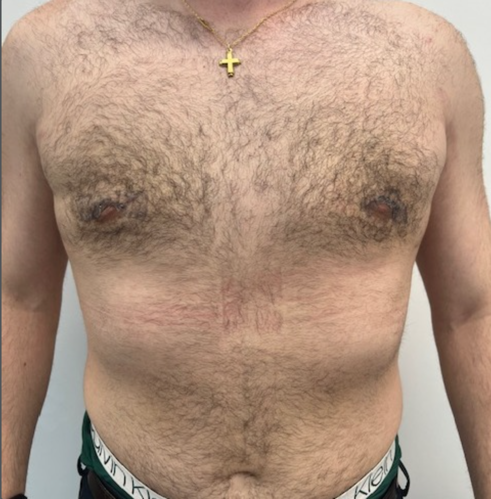 A shirtless man with a gold cross necklace showing his chest and abdomen, with noticeable chest hair and some skin redness and lines.