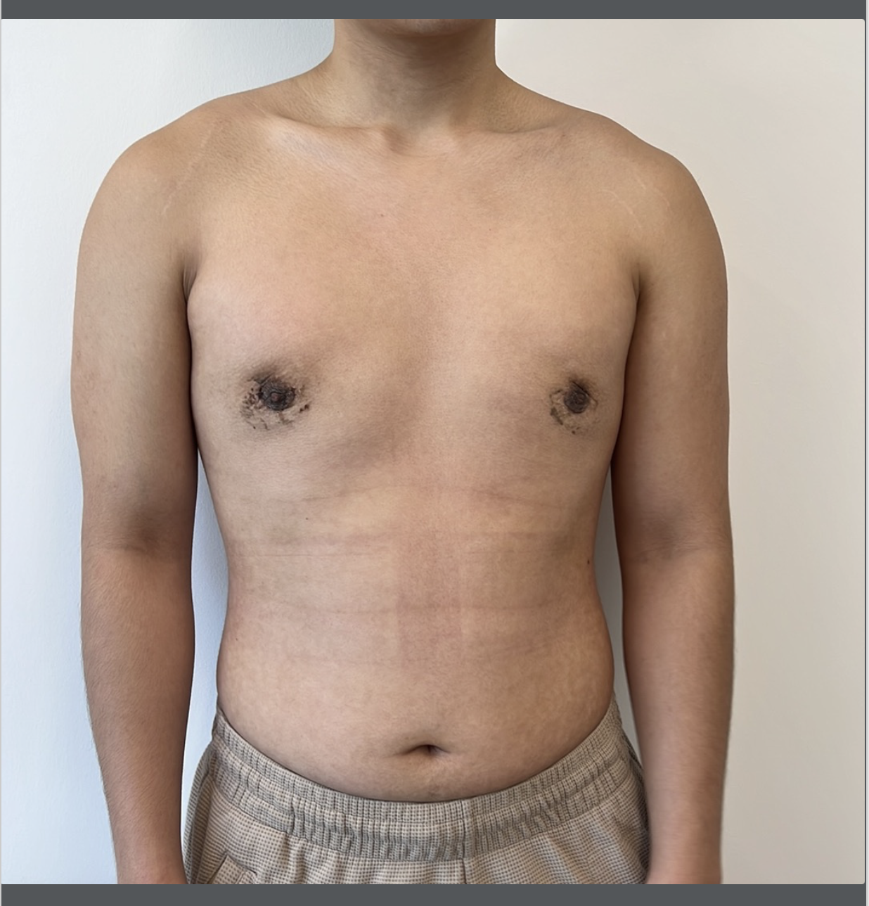 Front view of a shirtless person with light brown skin, showing upper body including shoulders, chest, and torso, against a plain white background.