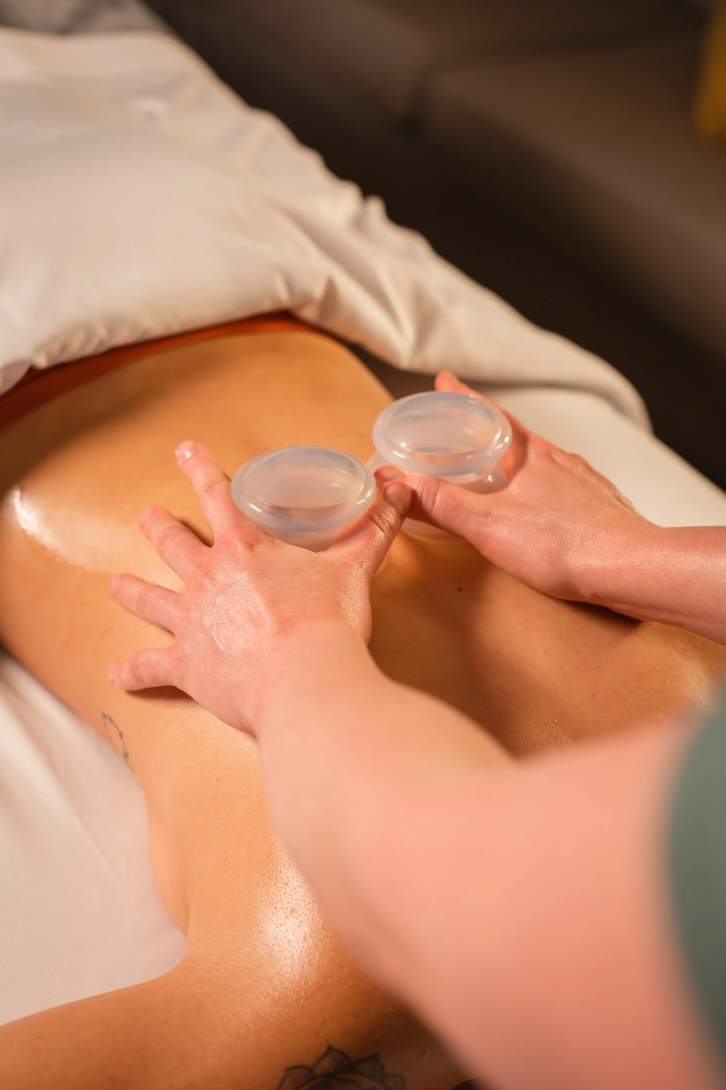 A person receiving a cupping therapy session on their back, with two glass cups placed on the skin by the therapist.