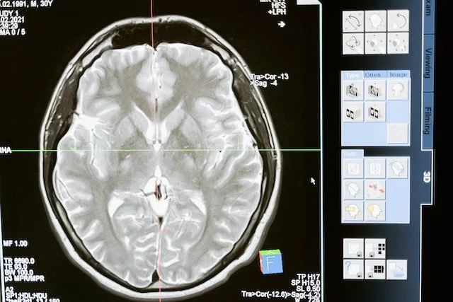 Explaining where ADHD originates in the human brain