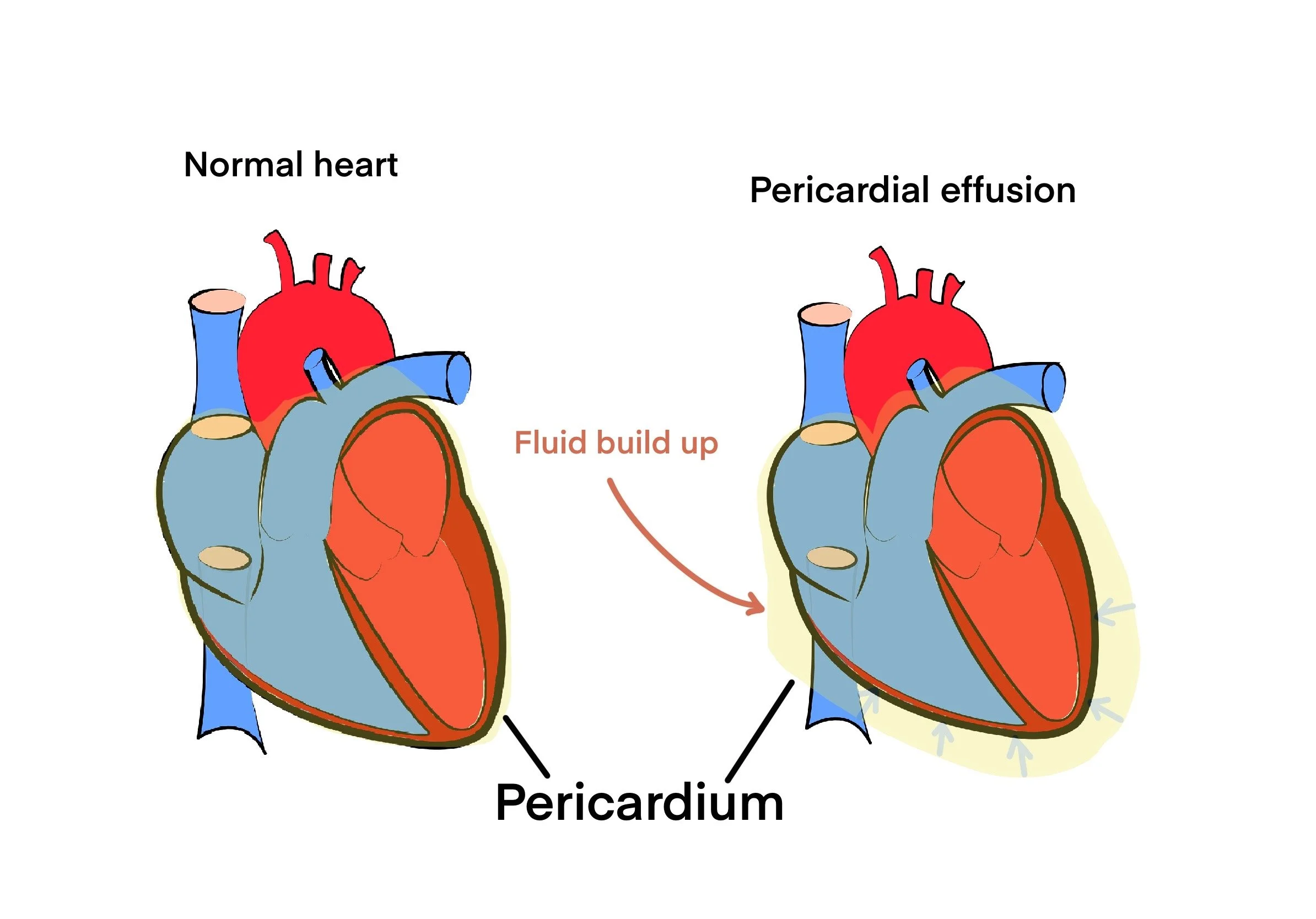 Pericardial Effusion — MY PA NOTES