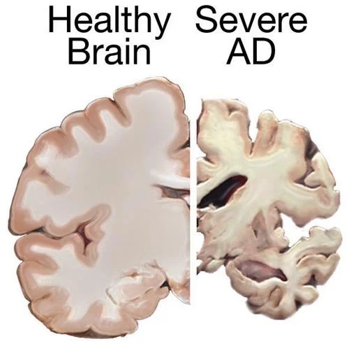 Dementia