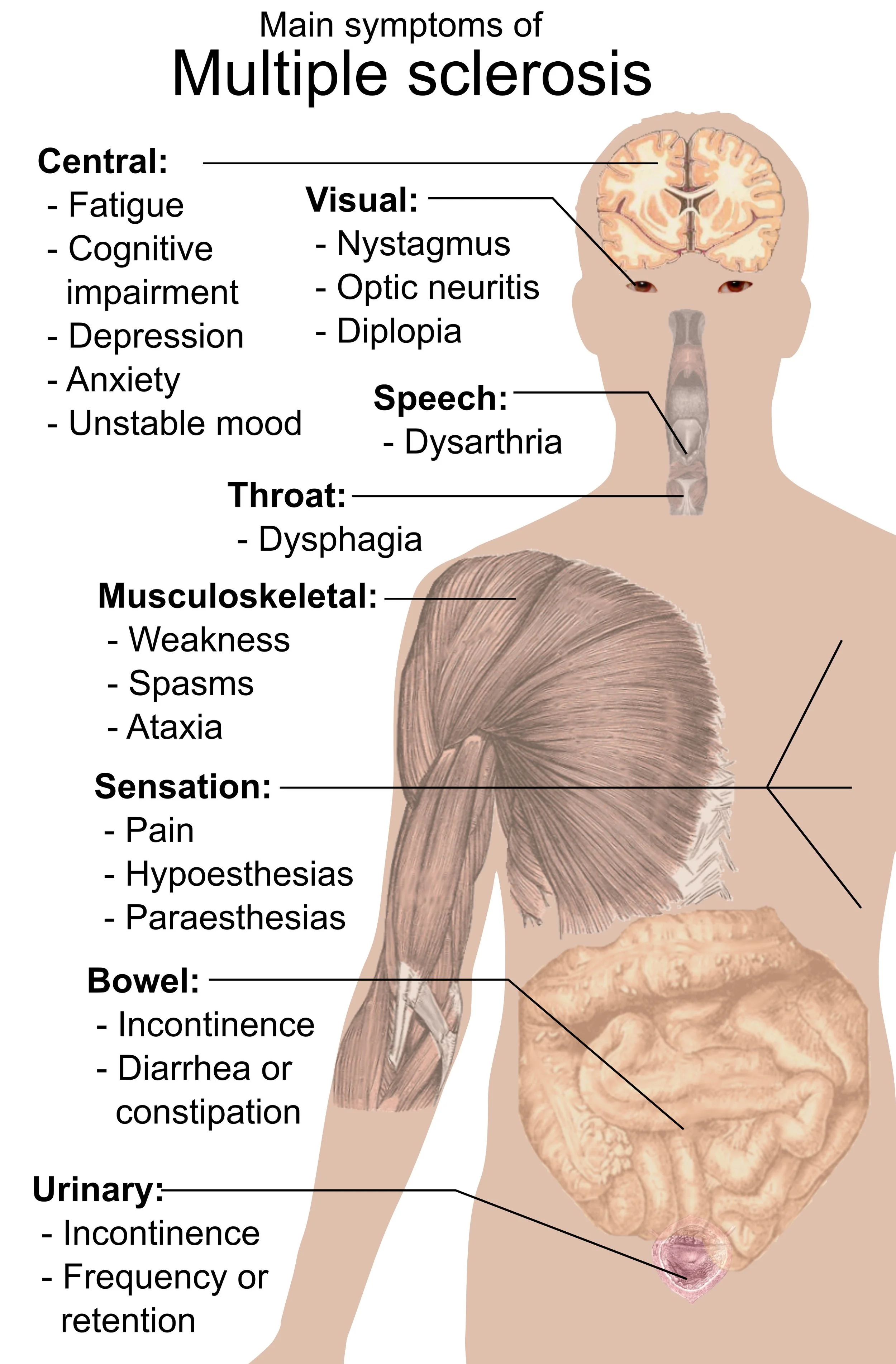 Multiple Sclerosis