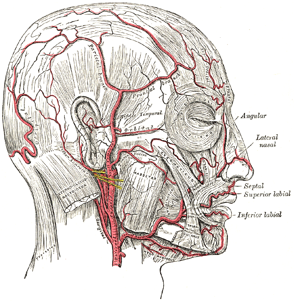 Temporal Arteritis (Giant cell Arteritis)