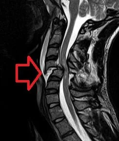 Spinal Cord Lesions
