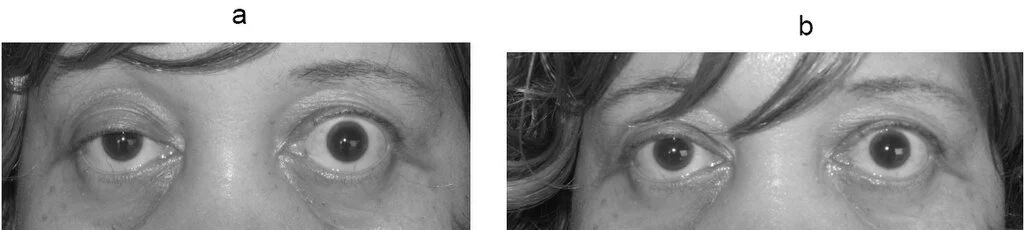 Myasthenia Gravis