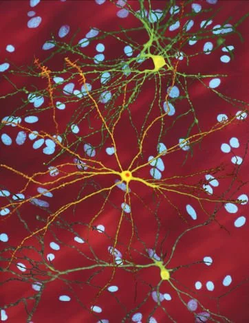 Huntington's Disease