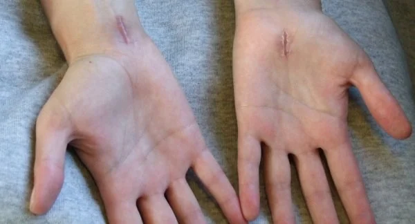 Carpal Tunnel Syndrome