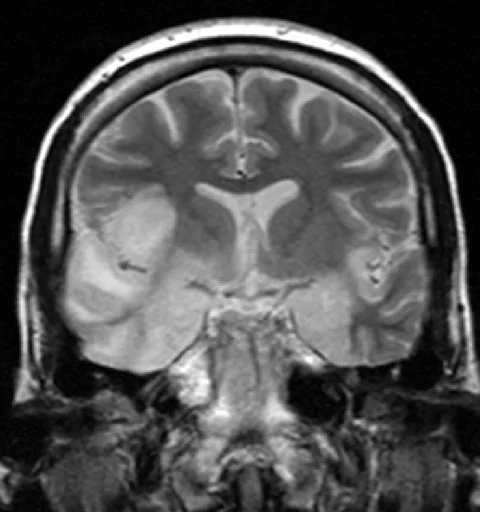 Encephalitis 