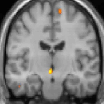 Cluster Headache