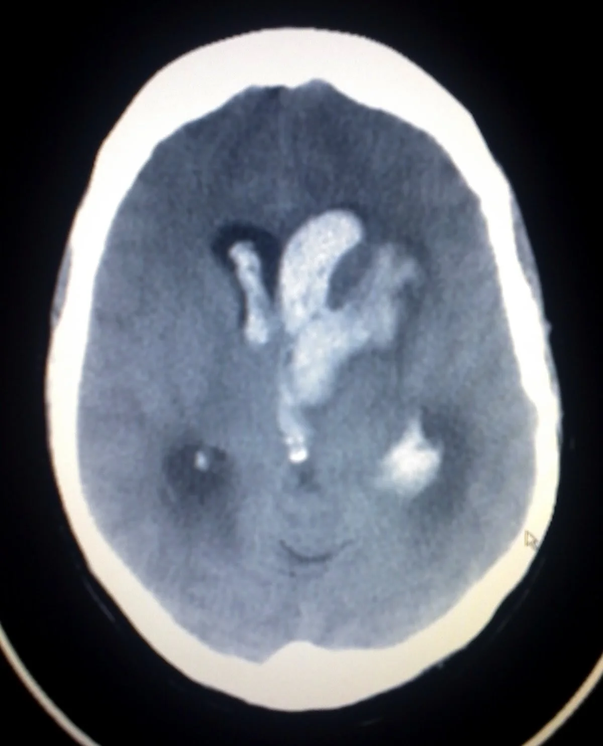 Intracerebral Haemorrhage