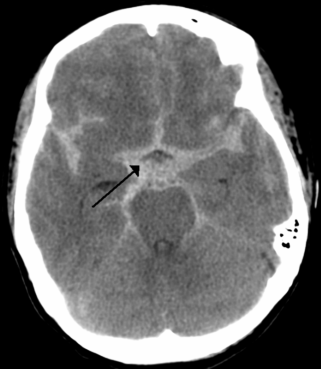 Subarachnoid Haemorrhage (SAH)