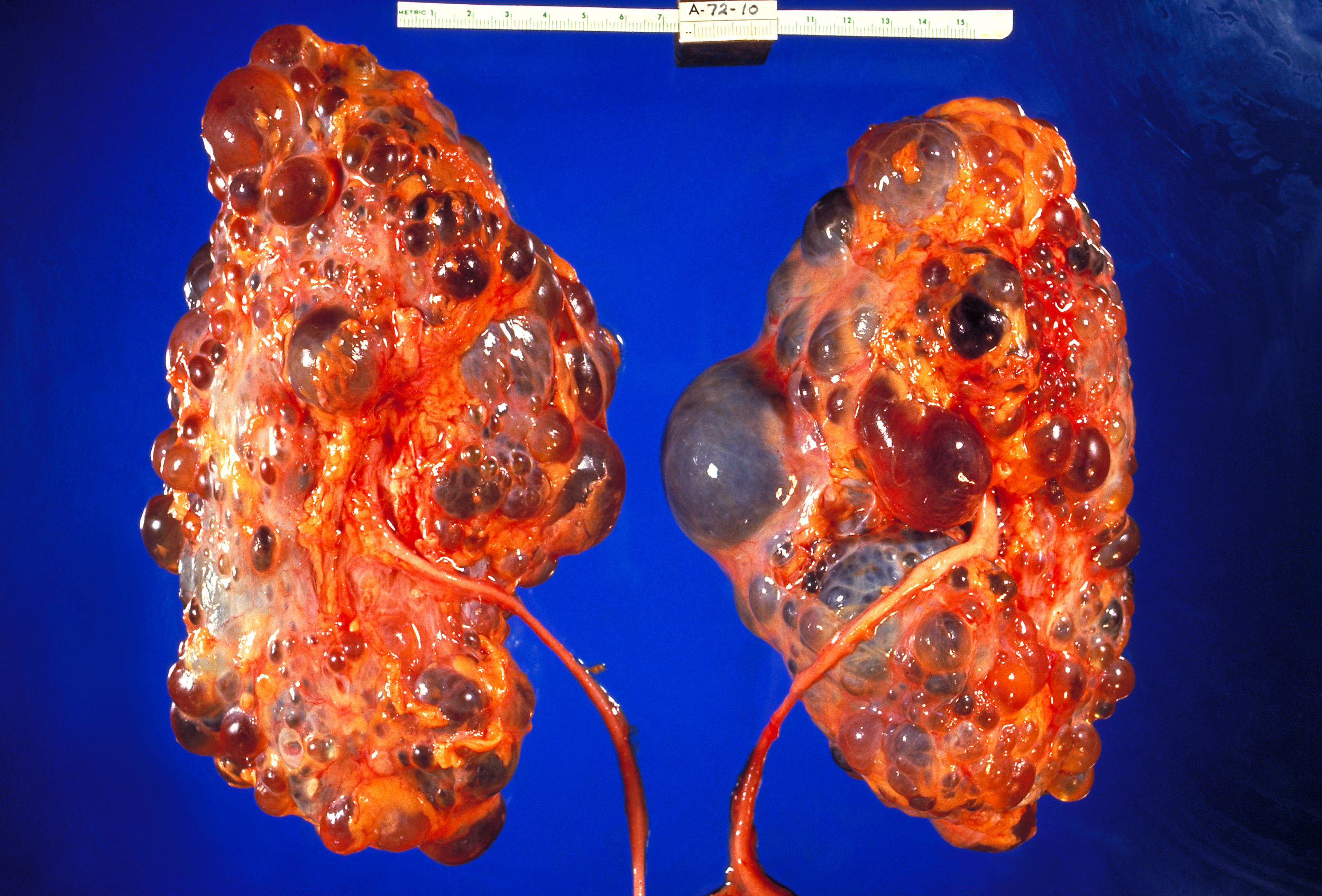 Polycystic Kidney Disease (PKD)
