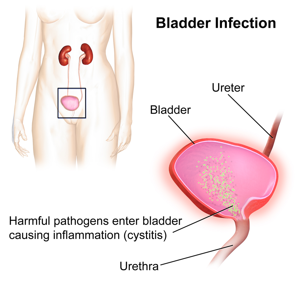 Urinary Tract Infection (UTI)
