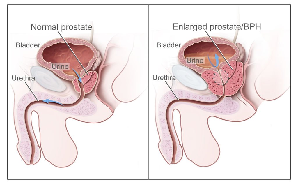 Benign prostatic hypertrophy