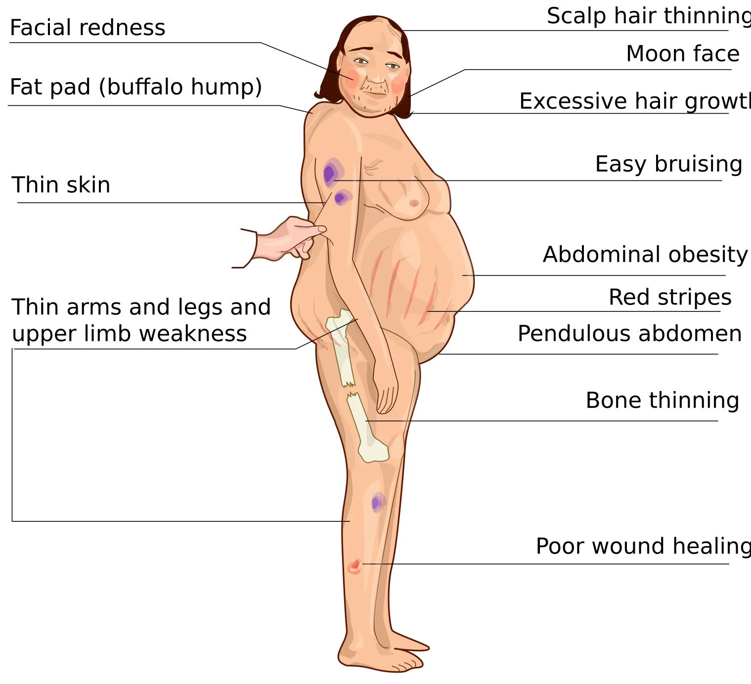 Cushing’s Syndrome