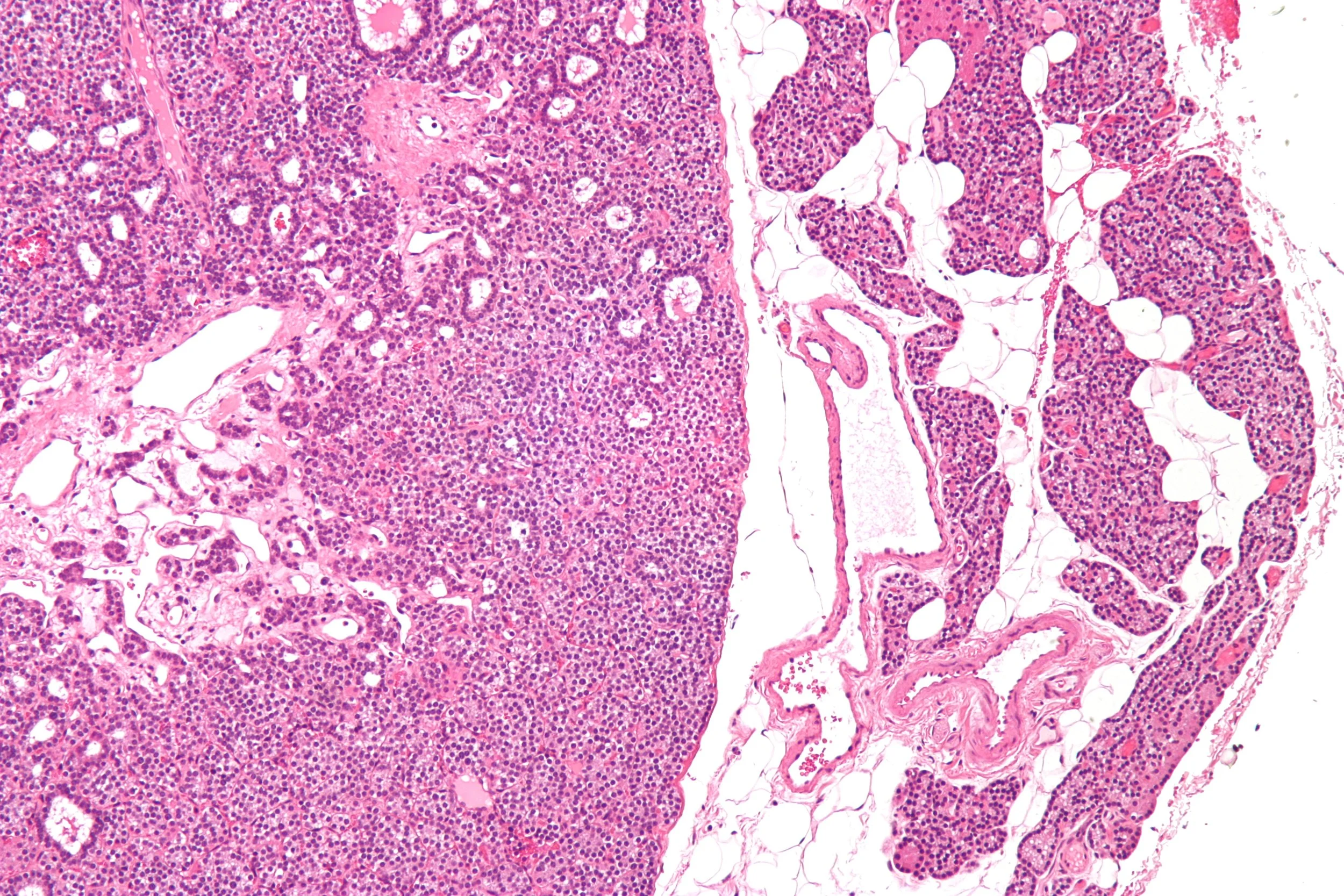 Hyperparathyroidism and Hypoparathyroidism