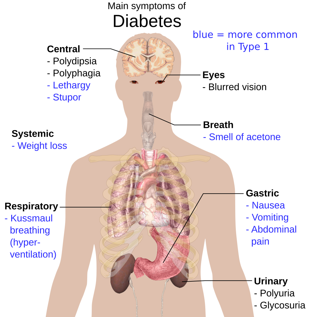 Diabetes Mellitus