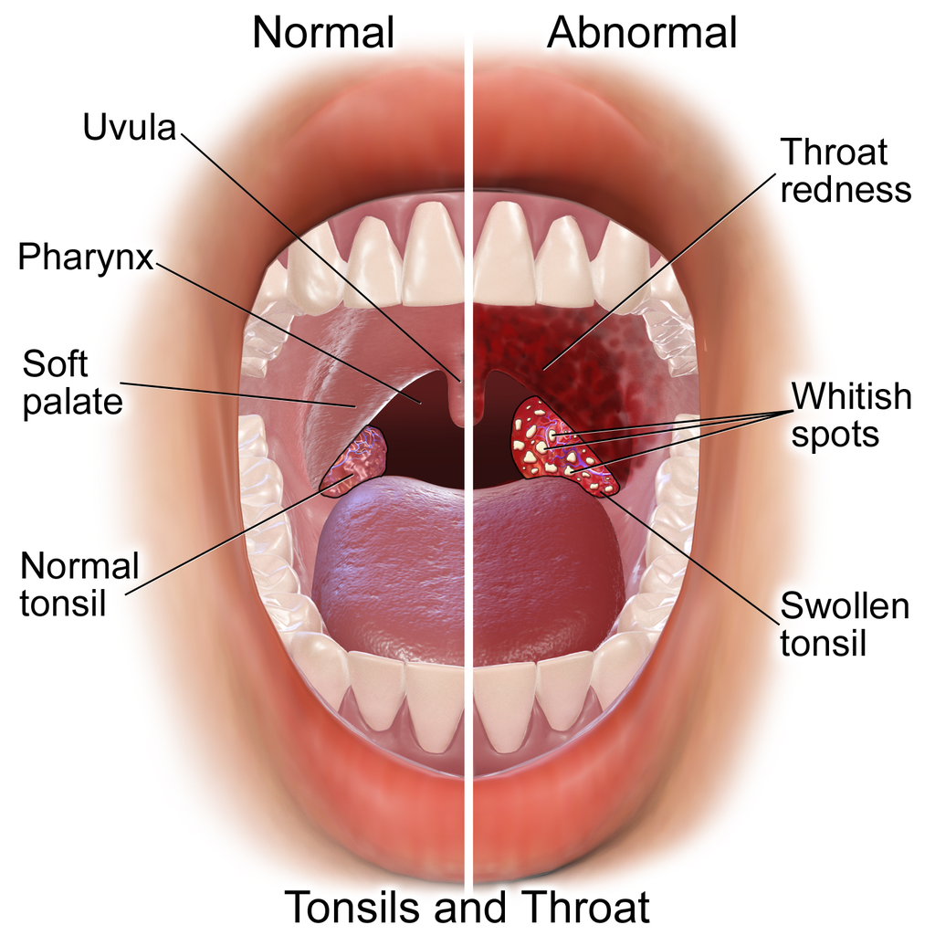 Tonsillitis and Pharyngeal Infections