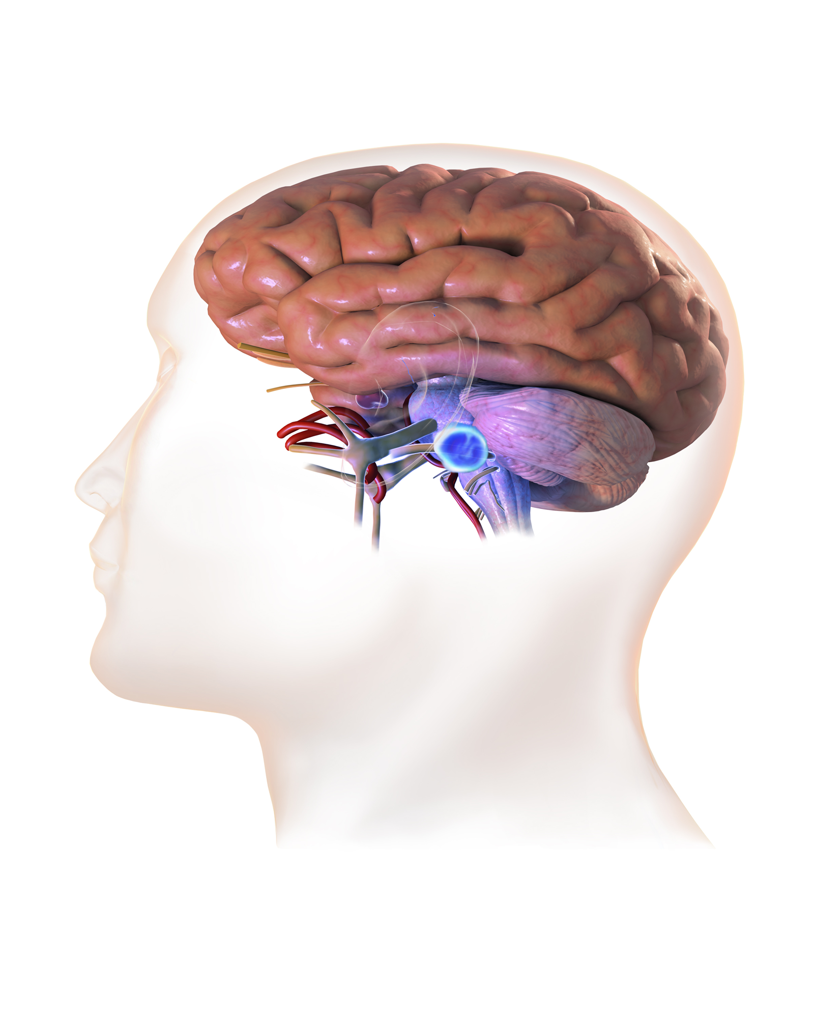 Acoustic Neuromas