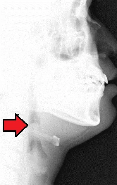 Epiglottitis