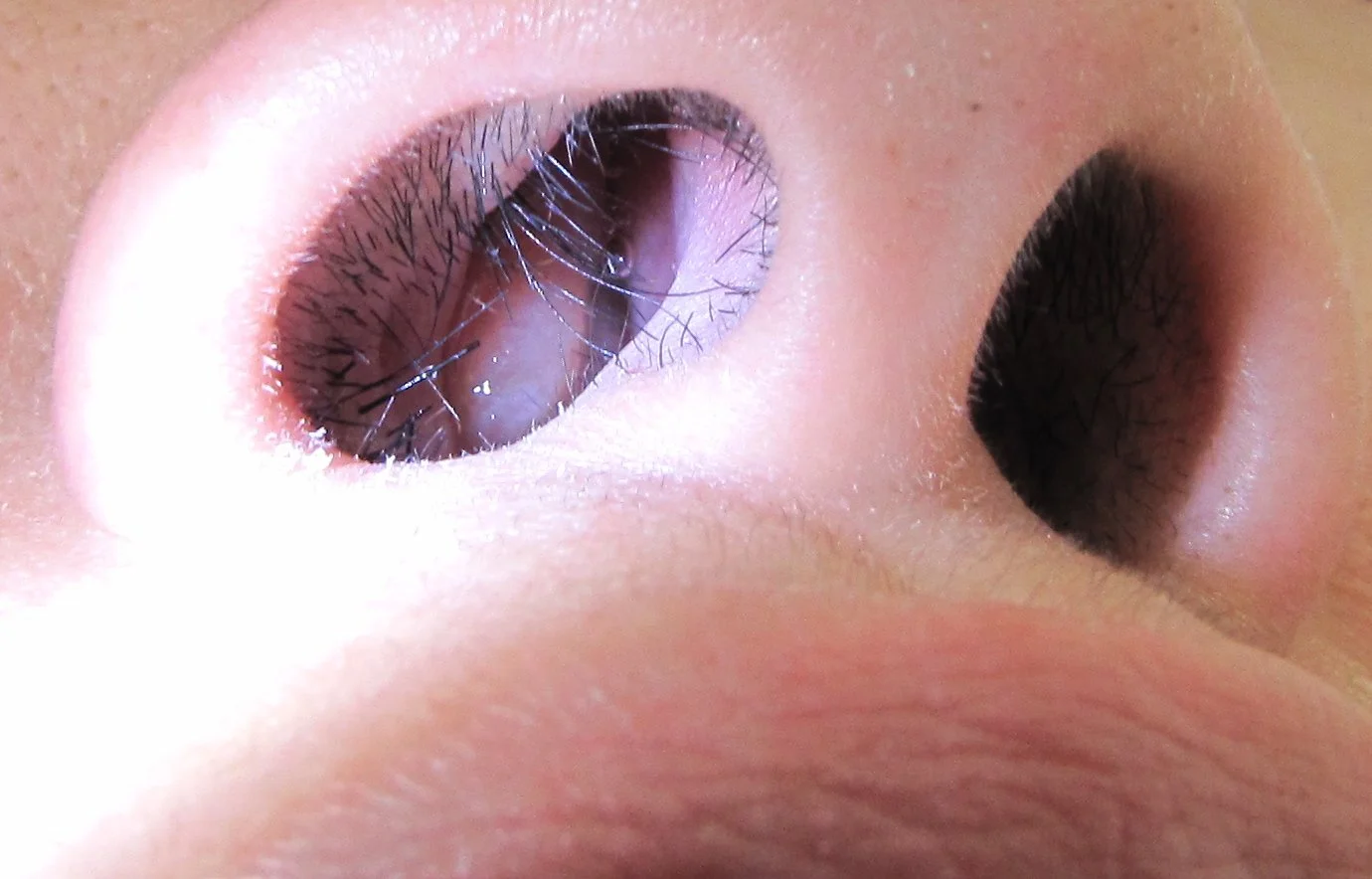 Nasal Polyps