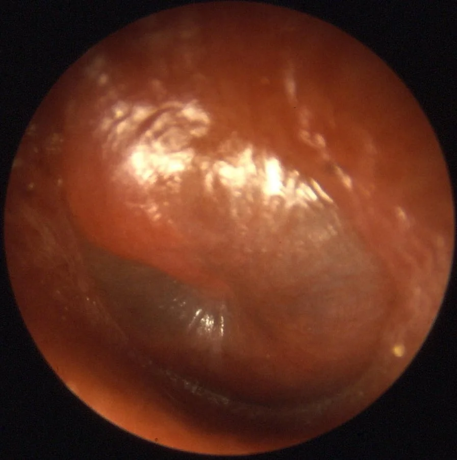 Ear infections